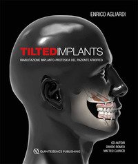 Tilted implants. Riabilitazione implanto-protesica del paziente atrofico